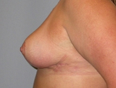 Patient # 92754 After Photo # 6